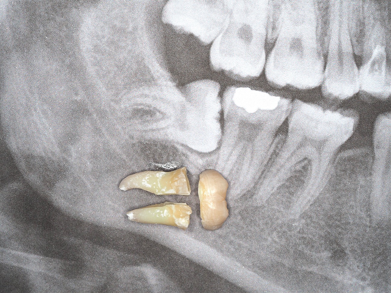 Wisdom Tooth Surgery